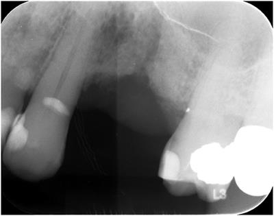 Malignant Lymphoproliferative Disorders of the Oral and Maxillofacial Region: Report of Two Institutions